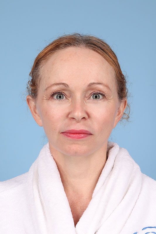 Facelift Before & After Image