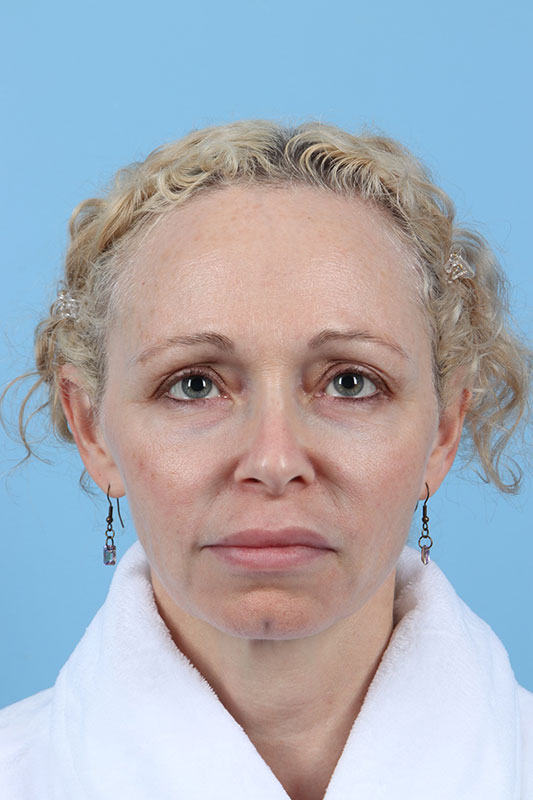 Facelift Before & After Image