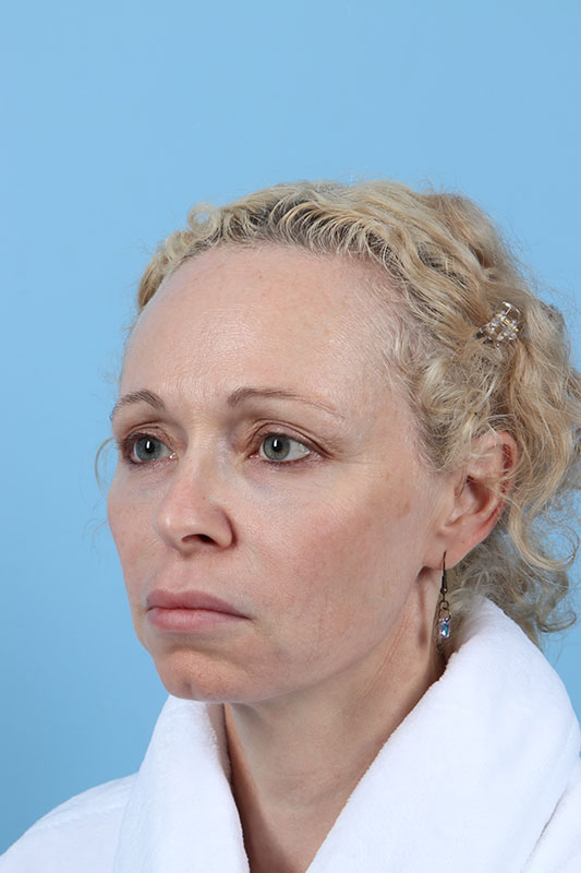 Facelift Before & After Image