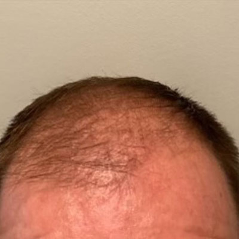 Hair Restoration Before & After Image