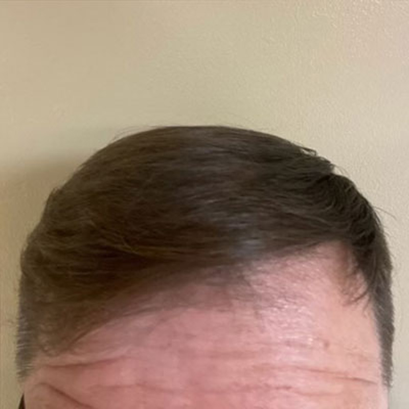 Hair Restoration Before & After Image