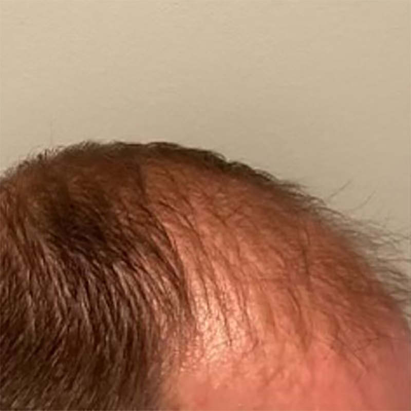 Hair Restoration Before & After Image