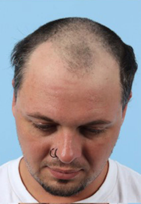 Hair Restoration Before & After Image