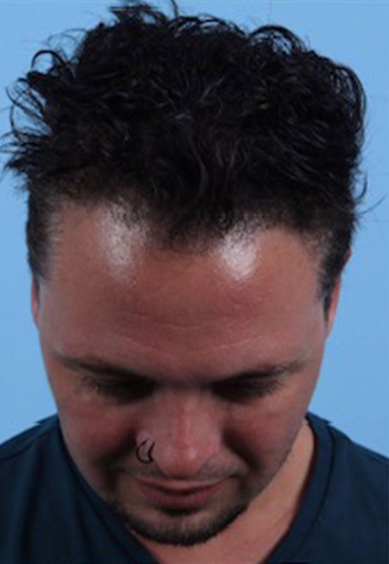 Hair Restoration Before & After Image