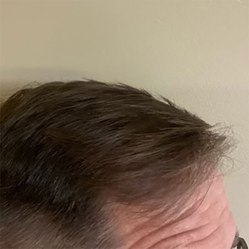 Hair Restoration Before & After Image